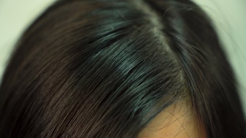 Woman Hair Who Have Problems with Dandruff