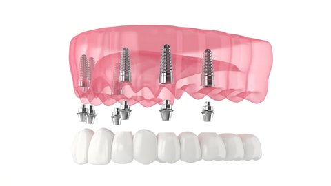 Upper jaw with prosthesis all-on-6 system supported by implants
