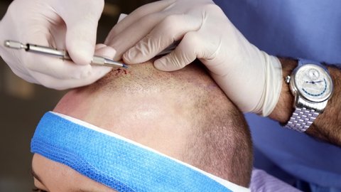 Doctor implanting hair follicles on scalp to treat baldness in live clinical setting (sequence 7 of 7)