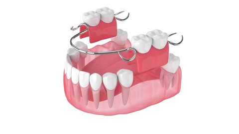 Removable partial denture isolated over white background