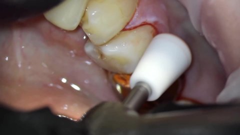 Dentistry Microscope Imaging Tooth Treatment Final Stock Footage Video ...