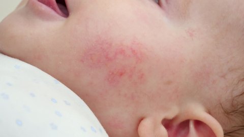 Closeup of baby face with red skin suffering from acne and dermatitis. Concept of newborn baby hygiene, health and skin care.