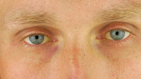 Mens eyes obstructive Jaundice yellowish. Real people liver dysfunction icteruswith cirrhosis hepatitis symptom face skin. Young man bilirubin pigmentation biliary tract obstruction Gilbert's syndrome