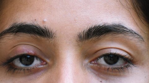 Closeup shot of face of Indian woman with one eye infection, upper eyelid painful stye with nodule. Concept of health, disease and treatment	
