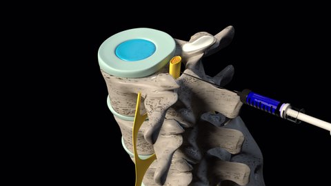 3d animation of the epidural steroid injection