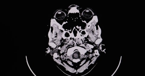 CT brain cine scan of a patient with left side hemiplegia showing large intracerebral hemorrhage and hematoma at right basal ganglia. Diagnostic CT footage.