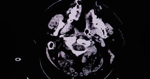 A CT scan of the brain of a patient with accident showing acute subdural hematoma and marked cerebral edema. Diagnostic CT footage. Animated or animation CT film.
