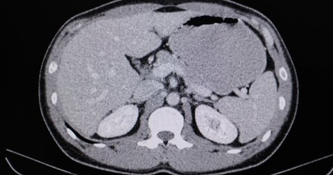 A motion CT scan of the abdomen of a male patient with testicular cancer. Animated or animation CT film.