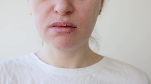 Close up of girl lips affected by herpes. Treatment of herpes infection and virus. Part of young woman face, lips with herpes affected. Beauty dermatology concept