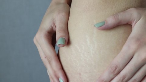 A woman showing her stretch marks on her hips. Female thighs with stretch marks on the skin.