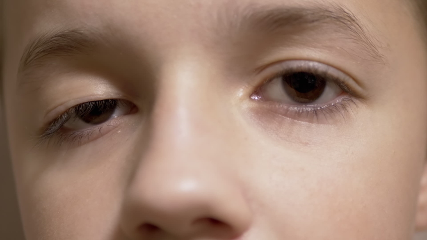 Boy with Drooping Upper of Eyelid, Long Lashes. Myopia. Ptosis. Pupil Rotation. Strabismus. Horner-Claude Syndrome. Facial nerve problem. Surgery. Bad vision. Blepharoplasty plastic. Close-up. Zoom. Royalty-Free Stock Footage #1074577493