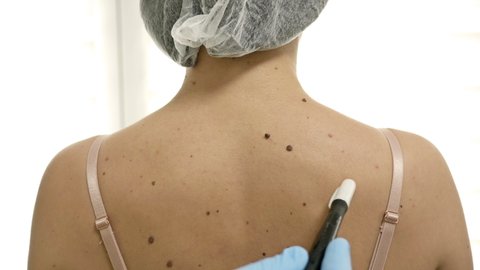 Dermatologist examining moles of female patient.
