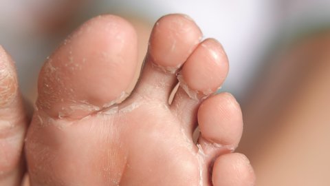 female feet during an acid peeling procedure.skin renewal and regeneration. skin restoration. foot care. health and hygiene.