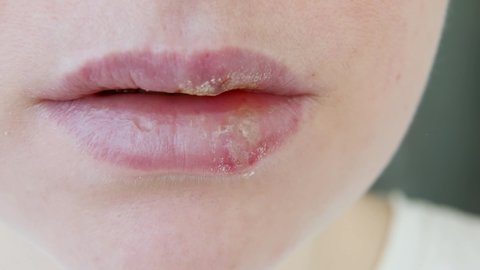 Close up of girl lips affected by herpes. Treatment of herpes infection and virus. Part of young woman face, lips with herpes affected. Beauty dermatology concept.