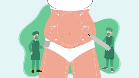 Two plastic surgeons animation drawing lines with marker on patient belly while doing surgery and liposuction. Cartoon in 4k resolution