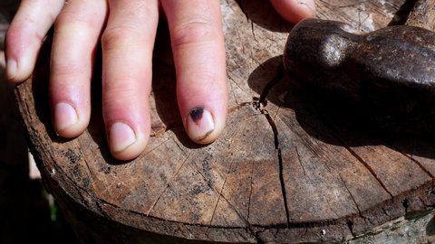 Hammer and human finger with dark bruised nail. Finger injury. Black hematoma on nails after hammering. Dangerous job.