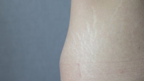 A woman showing her stretch marks on her thighs.