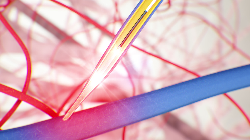 Varicose veins and legs Stock Video Footage - 4K and HD Video Clips