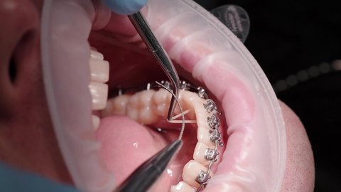 Bracket systems installation process. Patient in the dental chair. Modern orthodontics. Close-up
