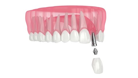 Upper jaw with dental implant installation over white background