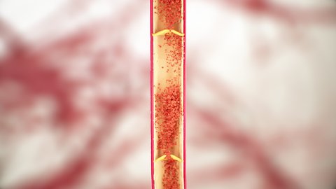 85 Peripheral Artery Stock Video Footage - 4K and HD Video Clips | Shutterstock 85 Peripheral Artery Stock Video Footage - 4K and HD Video Clips | Shutterstock
