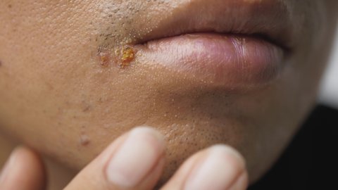 Lips herpes simplex virus symptoms. Man touching his wounded mouth from hurt and itching from disease.