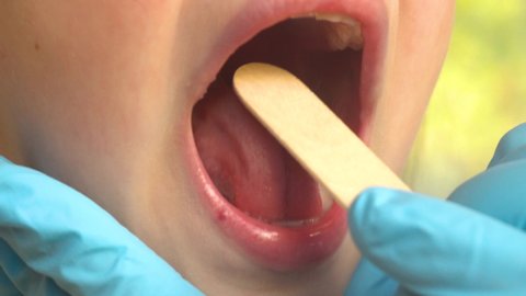 Close-up of a doctor examining a child's mouth and throat using a tongue depressor.ENT medicine.4k