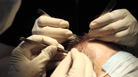 Macrophotography of a hair bulb transplanted into a hairless area. Baldness treatment. Hair transplant. Surgeons in the operating room carry out hair transplant surgery. Surgical technique that moves