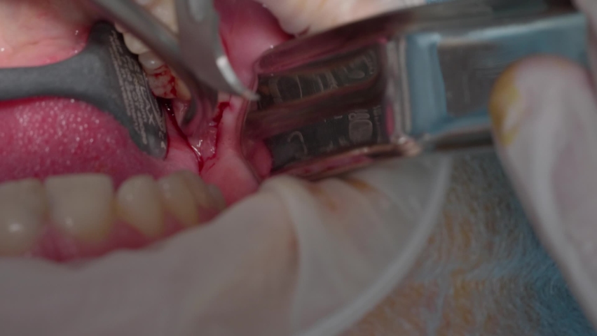 Close-up dentist surgeon makes an incision around the tooth Royalty-Free Stock Footage #1075899035