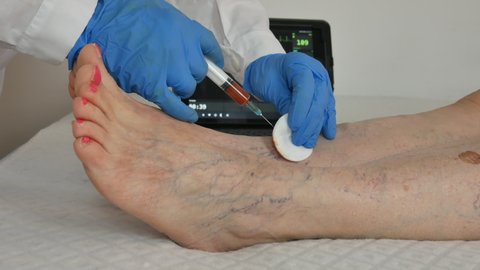 patient at the doctor with a syringe who has her legs checked varicose veins 