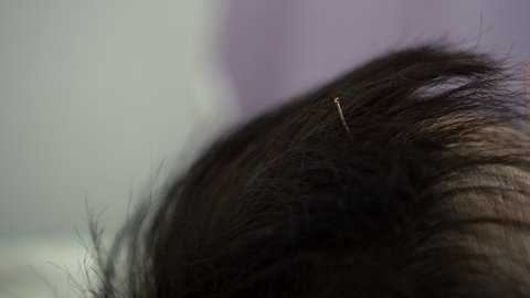 Chinese alternative treatment acupuncture needles on Asian man head hair rehabilitation to adjust yin yang flow in body