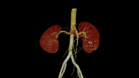 CTA Abdominal​ or CTA​ renal adtery 3D rendering image  rotating on the screen showing both kidney.