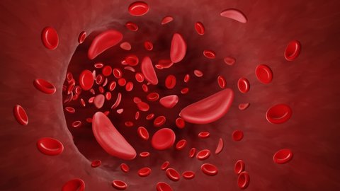 Sickle cell anemia, Sickle cells in blood stream