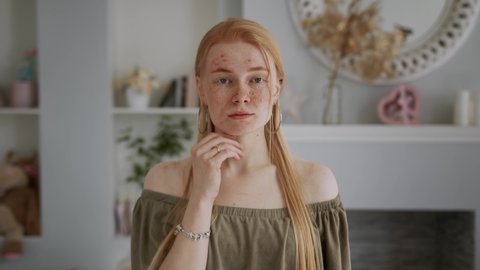 Young Beautiful Redhead Girl with Problem Skin Looks at the Camera Like in a Mirror. Acne treatment stages - 9th day of 28. Commercial ready woman skincare concept.