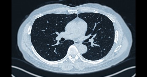 CT Chest or CT Scan of Lung axial MIP View for diagnosis TB,tuberculosis and coronavirus or covid-19 .