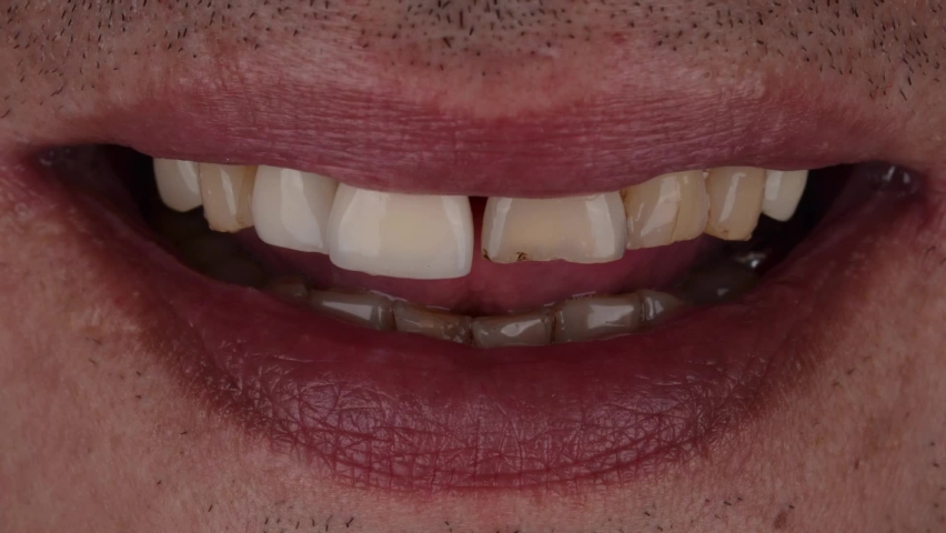 Before and after of Hollywood smile makeover with ceramic veneers and crowns. Royalty-Free Stock Footage #1076472266