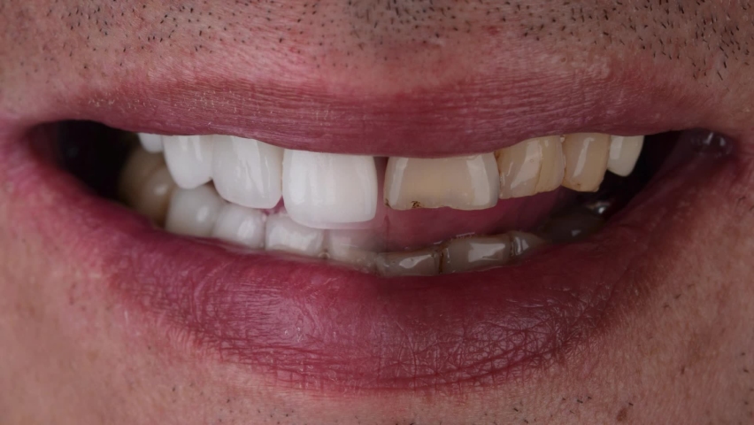 Before and after of Hollywood smile makeover with ceramic veneers and crowns. | Shutterstock HD Video #1076472266