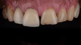 Smile make over changing yellow teeth to white teeth with ceramic veneers.