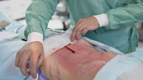 Patient's abdomen after liposuction procedure. Fat removal surgery. Plastic surgeon finishing the operation of liposuction and liposculpture. Patient's body during surgery.