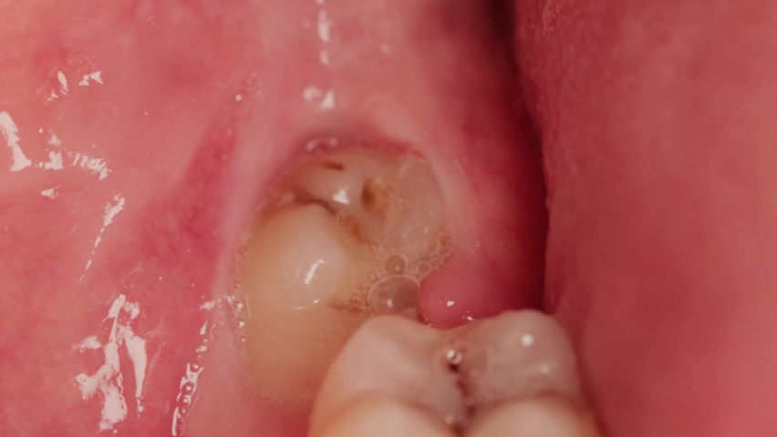 Impacted wisdom tooth due to which a gum hood was formed. Inflammation of the gums due to an unerupted molar, macro Royalty-Free Stock Footage #1076772125