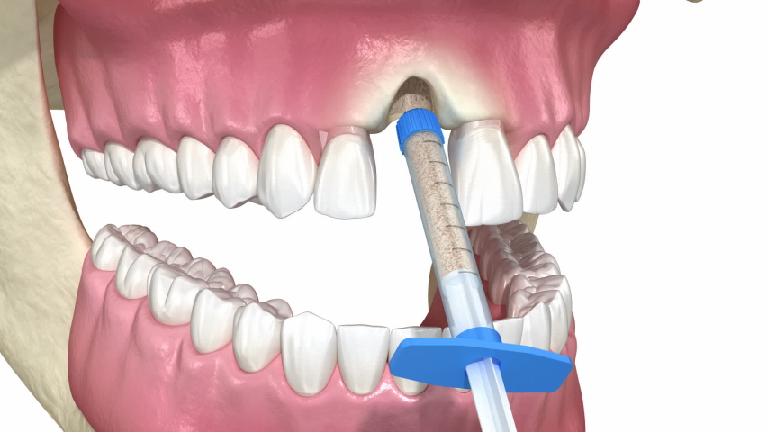 Bone grafting augmentation, socket preservation, tooth implantation. Medically accurate 3D animation. | Shutterstock HD Video #1076805881