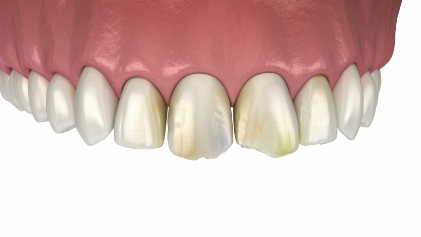 Veneers - preparation, mockup, color choosing and placement of dental veneers over central incisor and lateral incisor. Medically accurate tooth 3D animation Royalty-Free Stock Footage #1076805884
