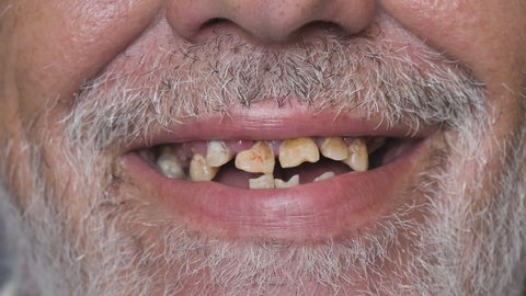 close-up shot of a toothless male mouth.A man with bad teeth. Man showing his rotten teeth, caries, decayed and weak enamel, teeth falling out, dental problems
