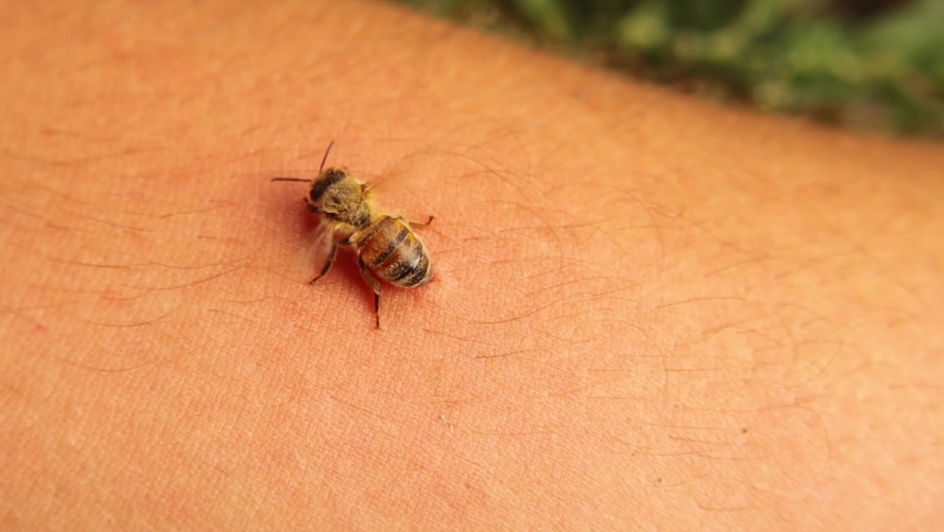 Honey bee stings a man's arm.
When the sting is over, the honeybee leaves the venom gland and notices that it's still injecting the venom on its own.
The best way to remove a stinger is to use forceps Royalty-Free Stock Footage #1077050168