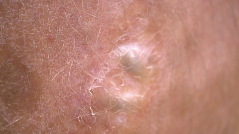 Varicose veins can be seen under the skin on the leg men macro.