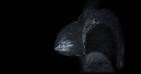 Breast MRI or magnetic resonance imaging Sagittal T2W of Breast in women for screening breast cancer.
