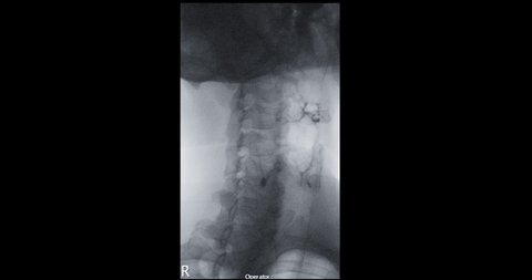 Barium Swallow under fluoroscopic control showing epiglottis anatomy for diagnose disphagia from GERD ulcers series or esophageal cancer.

