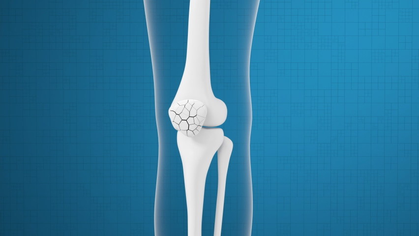 Leg bone and knee healing, 3d rendering. | Shutterstock HD Video #1077498650