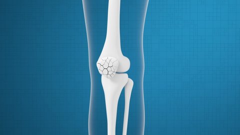 Leg bone and knee healing, 3d rendering.