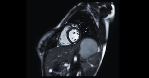 MRI heart or Cardiac MRI ( magnetic resonance imaging ) of heart in short axis view showing heart beating for detecting heart disease.